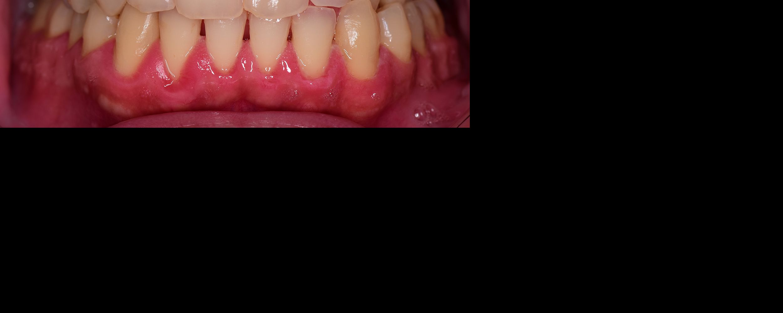 Periodontal Gum Treatment