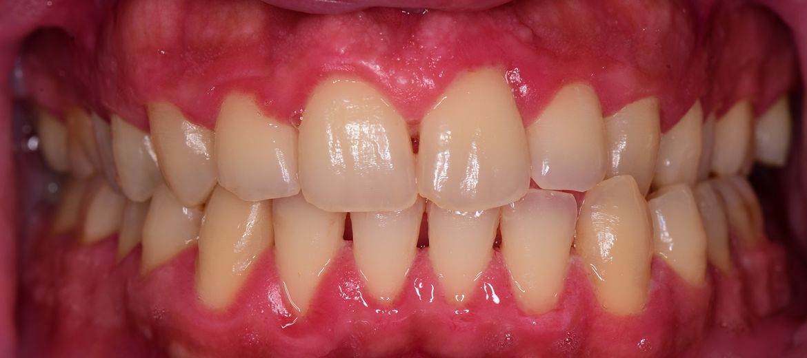 Periodontal Gum Treatment