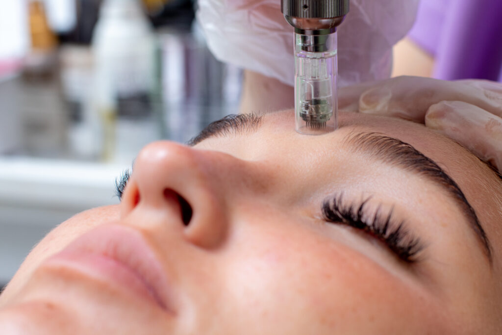 micro needling Hull